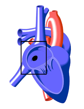 Atrial Septal Defect
