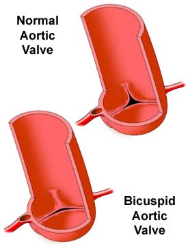 Bicuspid Aortic Valve