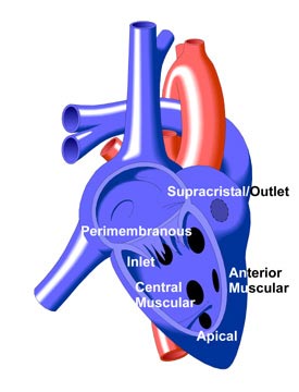 Variations of VSD