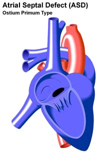 Atrial Septal Defect