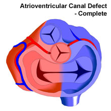Atrioventricular Canal Complete