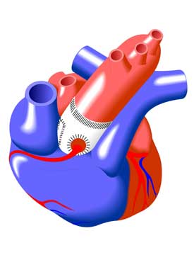 Aortic Root Replacement