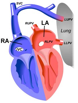 Partial Anomalous Pulmonary Venous Return