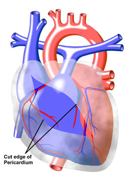Pericarditis