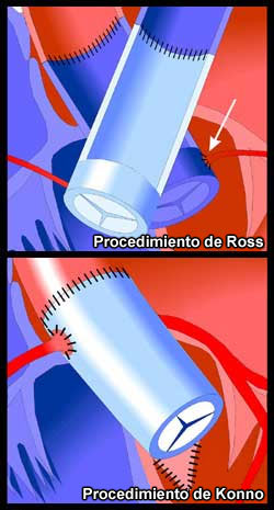 Ross & Konno Procedures