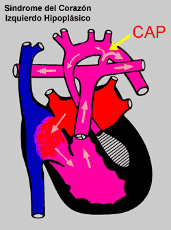 Hypoplastic Left Heart Syndrome