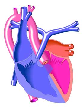 Tetralogy of Fallot