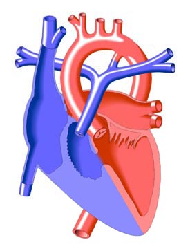Tricuspid Atresia