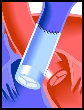 Tetralogy