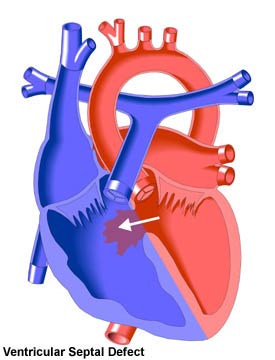Ventricular Septal Defect